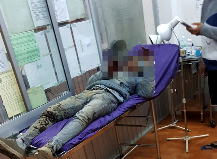 Người đàn ông đi xe máy sập hố sâu (đoạn qua mỏ đá Tây Đại Lào) té ngã bị gãy tay, chân bất tỉnh được người dân đưa đến Bệnh viện II Lâm Đồng cấp cứu vào đên 9/1/2021