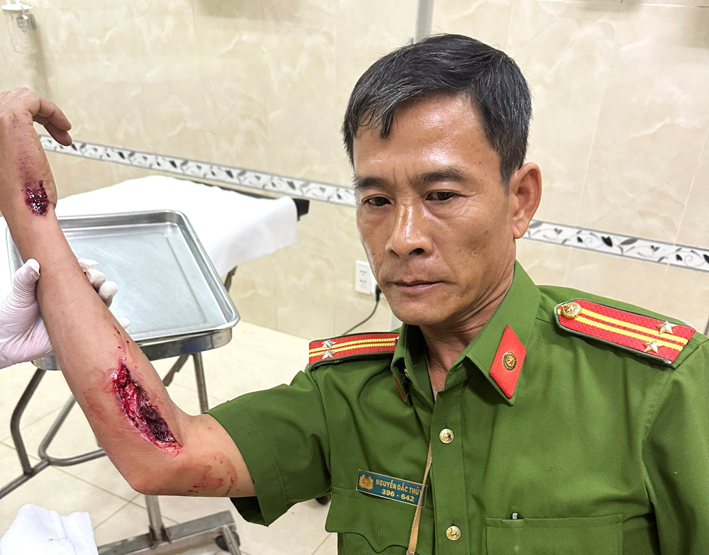 Vết thương của Trung tá Nguyễn Đắc Thủy bị người điều khiển xe máy vi phạm nồng độ cồn tông trúng