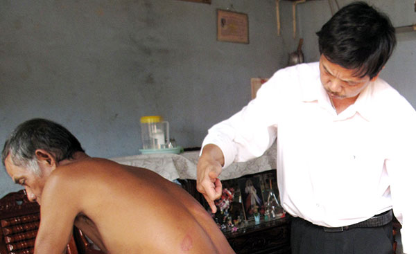 BSCK I Nguyễn Văn Chất - Đội trưởng Đội Vệ sinh phòng dịch - Trung tâm Y tế Bảo Lâm đang khám theo dõi tình trạng phản ứng phong tại nhà bệnh nhân