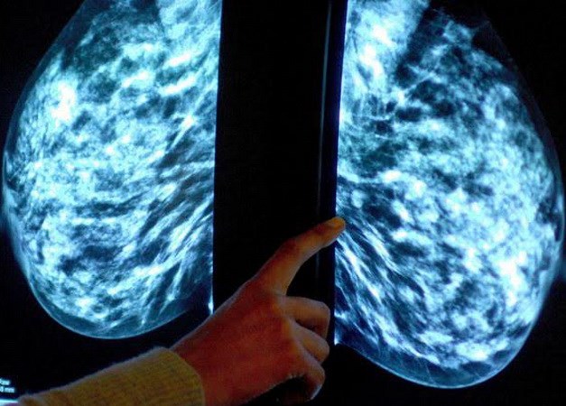 Chụp x-quang xác định bệnh nhân ung thư vú. (Nguồn: Mirror)