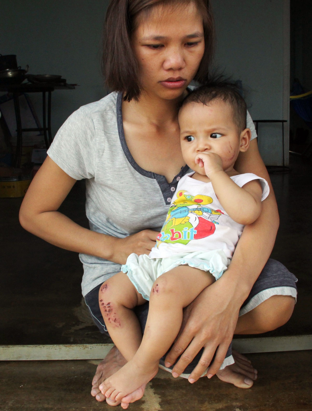 Sau 1 ngày ở nhà trẻ, bé gái 7 tháng tuổi bị thương tích đầy mình