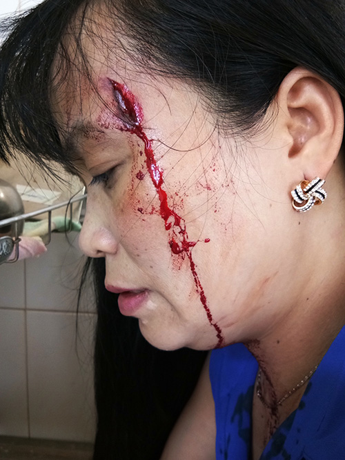 Bảo Lâm: Một tiểu thương bị bảo vệ chợ đánh nhập viện