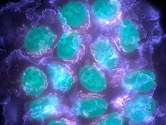 Xác định được các gene đột biến có khả năng gây bệnh ung thư vú