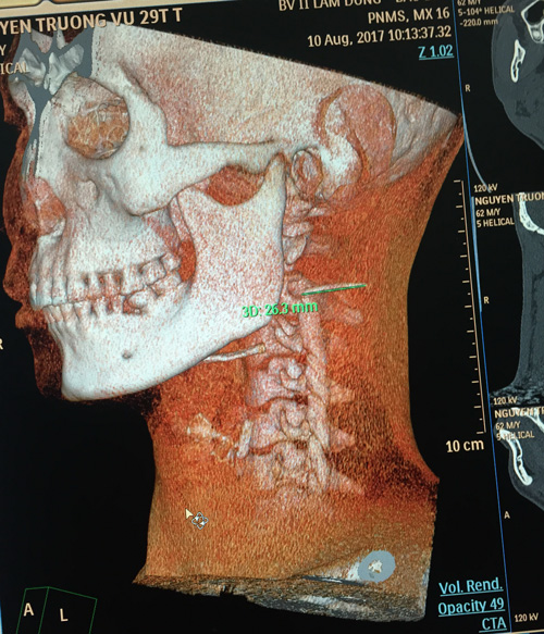 Hình ảnh CT Scaner cho thấy dị vật dã di chuyển ra sát động mạch cảnh trái