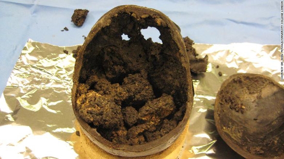 Hộp sọ có chứa mô não người tiền sử có niên đại khoảng 2.600 năm vẫn còn nguyên được phát hiện tại Anh