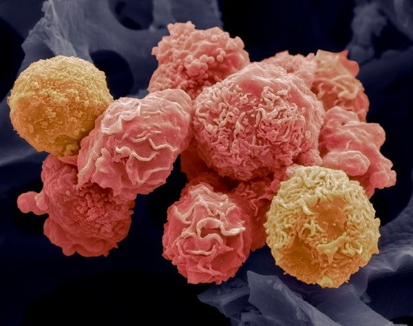 Tế bào ung thư cổ tử cung
