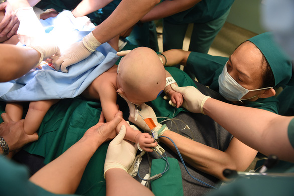 Ca phẫu thuật lần này có sự góp mặt của gần 100 bác sĩ để giúp hai bé có hình hài mới