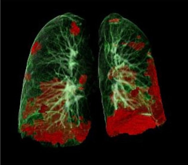 Chụp CT phổi của bệnh nhân cho thấy tổn thương COVID-19 màu đỏ.
