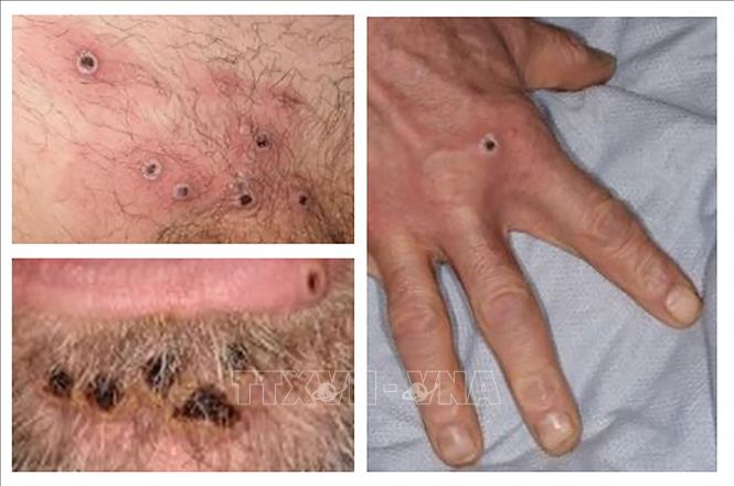 Các ban đậu mùa khỉ trên da của bệnh nhân