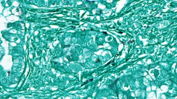 Tế bào nấm (màu đen) nằm trong mẫu mô khối u ung thư phổi (màu xanh)