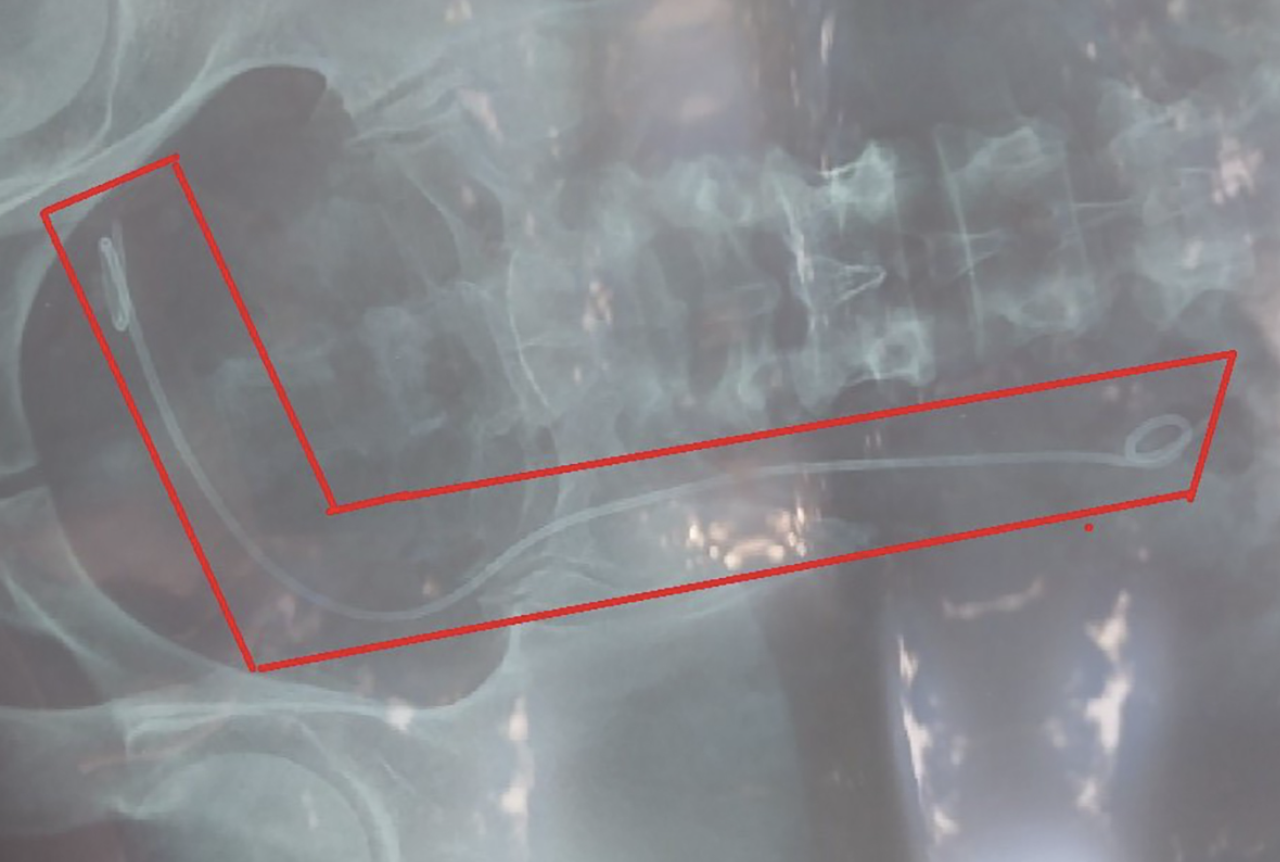 Vụ nhầm lẫn phim chụp X-Quang: Chỉ thủ thuật nội soi cho bệnh nhân, không phải mổ