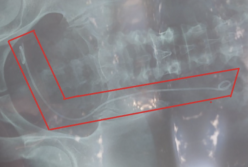Bệnh viện Đa khoa Lâm Đồng thông tin về việc nhầm lẫn phim chụp X-Quang của bệnh nhân