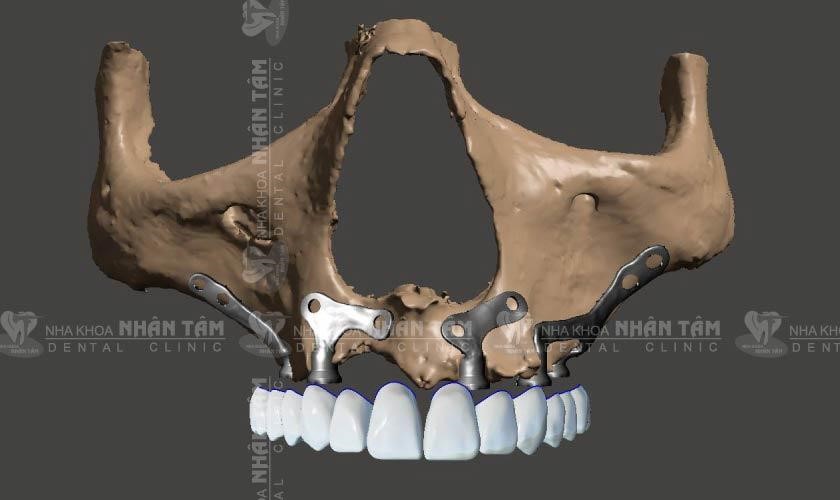 Implant cá nhân hóa được đặt phía trên xương hàm và bên dưới nướu