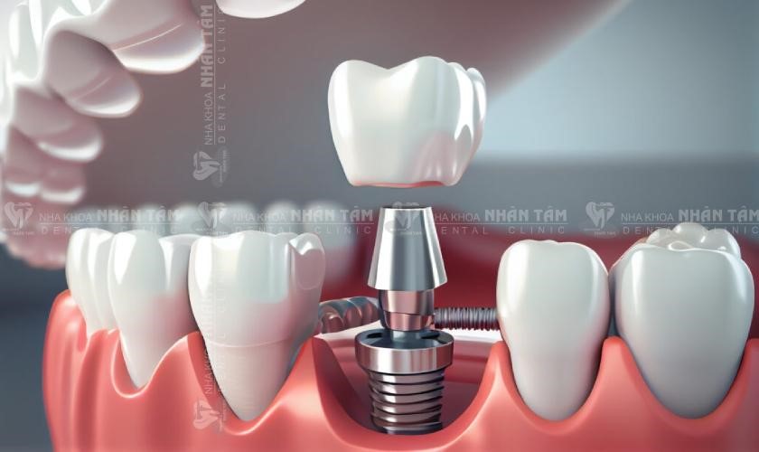 Implant thông thường được đặt vào bên trong xương hàm