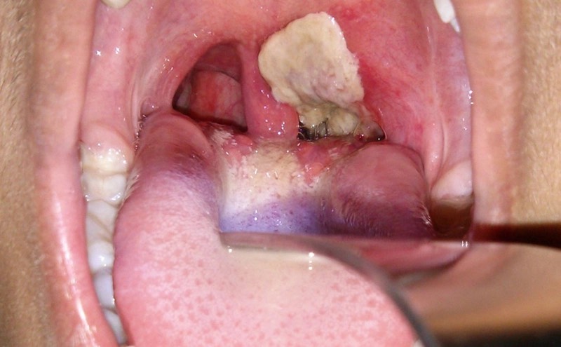 Một trong những triệu chứng của bệnh bạch hầu là xuất hiện giả mạc tại vùng hầu họng. (ảnh minh hoạ)