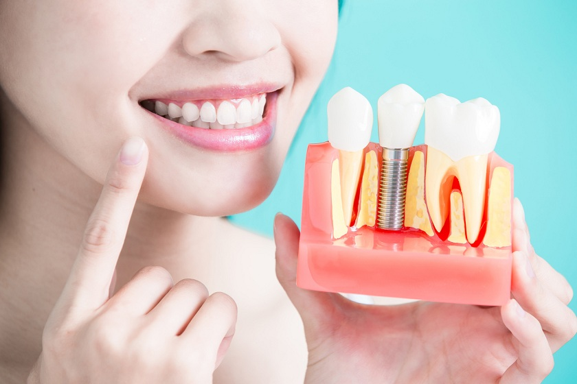 Trồng răng implant chuẩn chất lượng tại Bệnh Viện Răng Hàm Mặt Sài Gòn