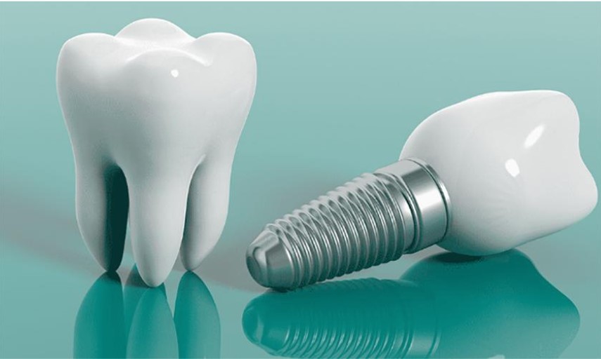 Chi phí cấy ghép Implant phụ thuộc vào rất nhiều yếu tố