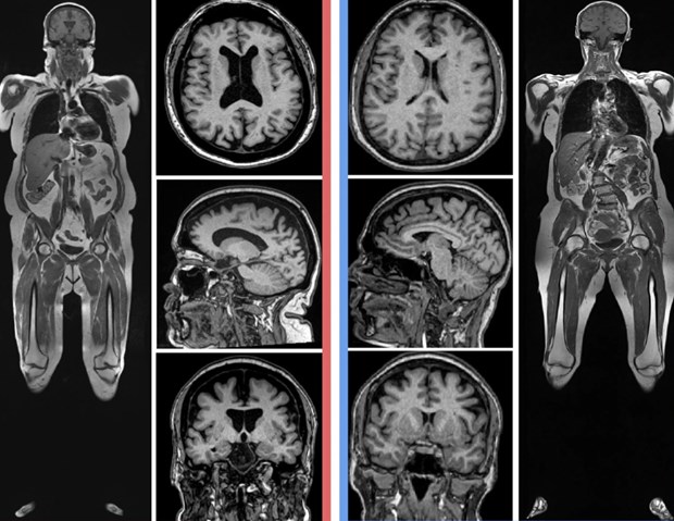 Chứng teo não xuất hiện rõ ràng với nhiều khoảng trống trong não ở người phụ nữ có lượng mỡ cơ thể cao hơn (bên trái)