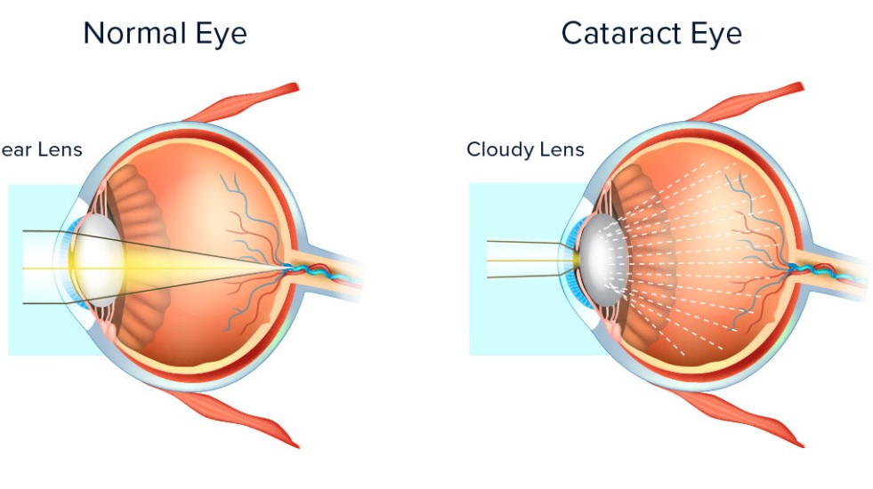 Hình ảnh về mắt của người bình thường (trái) và mắt của người đục thủy tinh thể