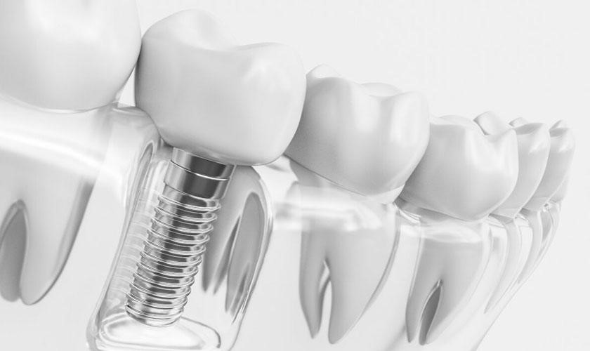 Số lượng răng implant thực hiện cũng ảnh hưởng đến chi phí trồng răng