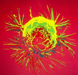 Nhật phát hiện ra loại gen đẩy nhanh di căn ung thư