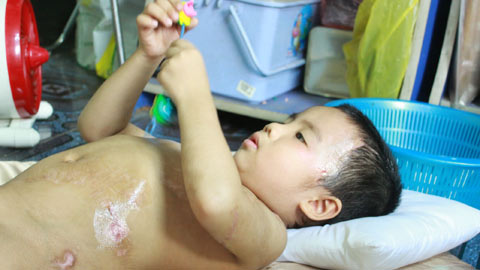 Sau hơn 1 tháng điều trị, nhiều vết thương vẫn chưa liền da. Ảnh: Vietnamnet.