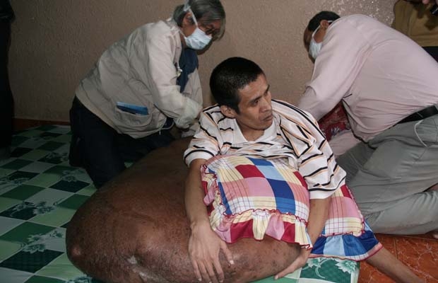 Người đàn ông mang khối u nặng trên 80kg ở Đà Lạt: “Căn bệnh hiếm gặp, xác suất mắc bệnh 1/3.000&quot;
