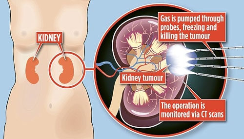 Khí Argon được bơm qua kim nhỏ, đóng băng và phá hủy khối u