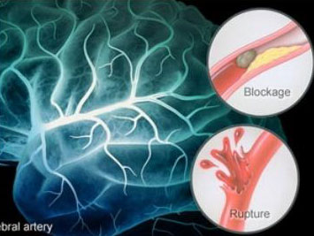 Giải pháp mới trong điều trị giảm nguy cơ đột quỵ