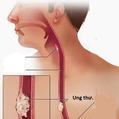 Chứng khó nuốt - Khó chữa?