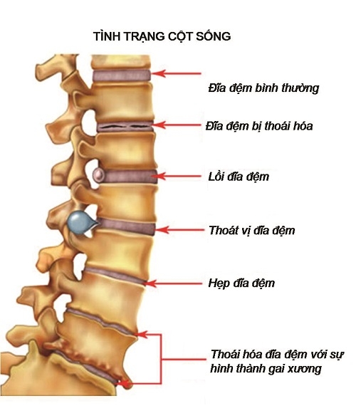 Bệnh gai cột sống và biến chứng