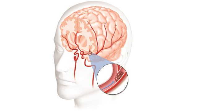 Xử trí đột quỵ não tại nhà