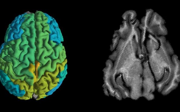 Kỹ thuật MRI mới giúp sớm phát hiện các căn bệnh thoái hóa thần kinh