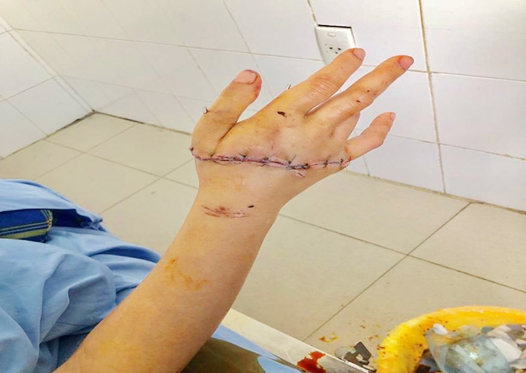Các Bác sĩ BVĐK Lâm Đồng thực hiện thành công ca phẫu thuật nối liền bàn tay bị đứt lìa